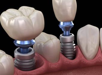 What Are The Types of Dental Implants?