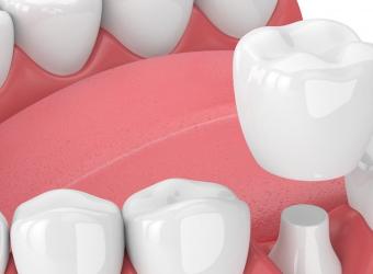 Do Kids Need Dental Crowns?