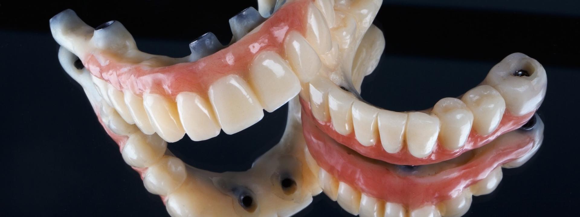 Implant supported dentures