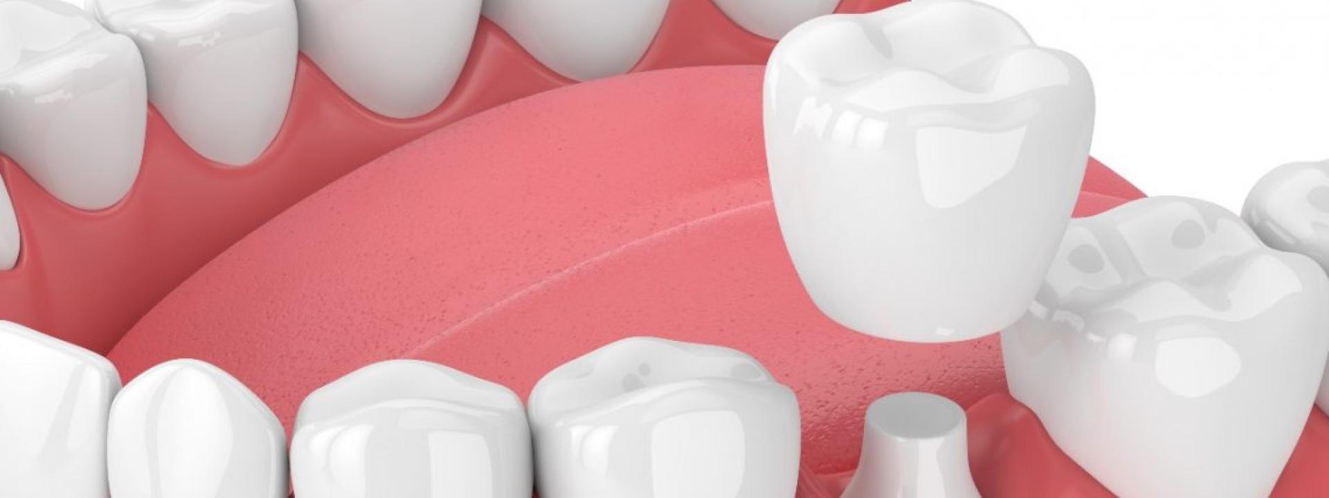 dental crowns