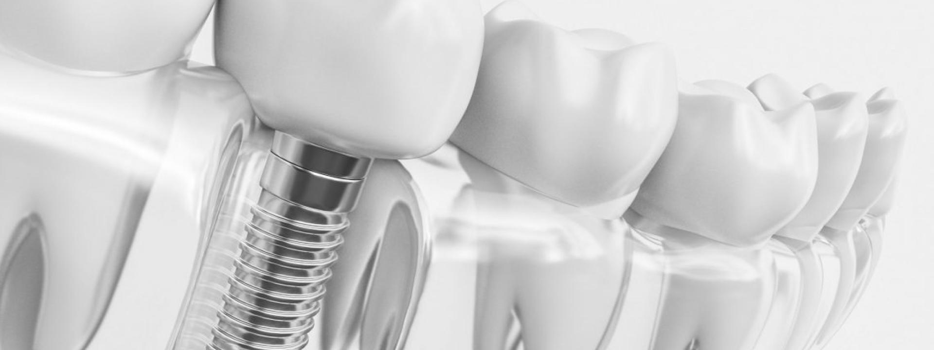 Dental Implant