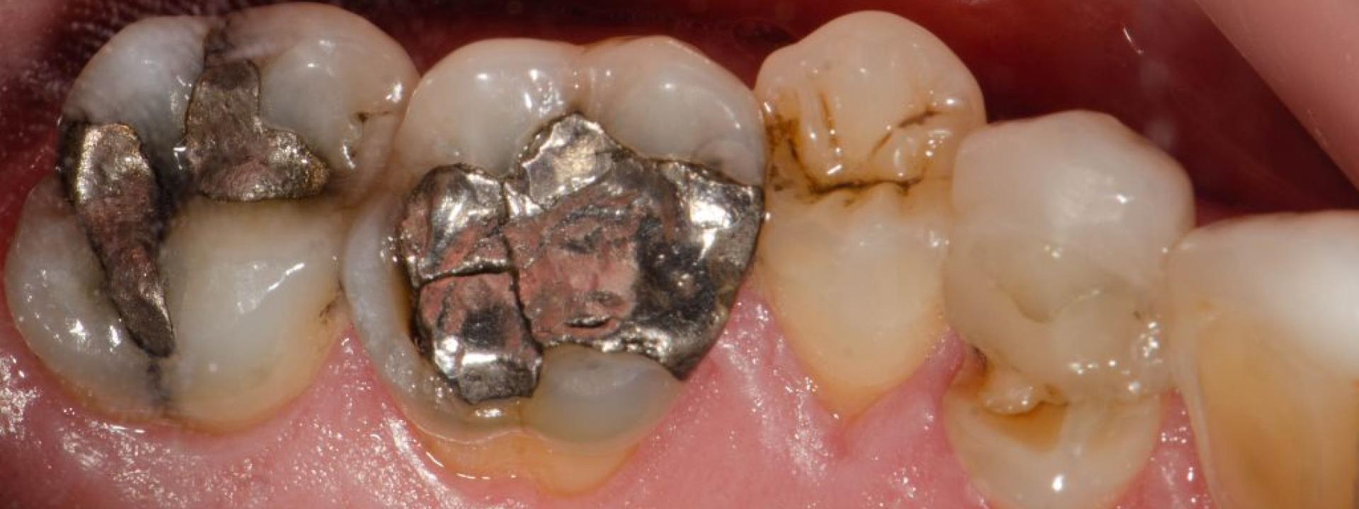 Broken amalgam fillings with mercury